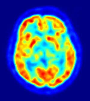 Positron emission tomography (PET) measures actual changes in the brain that occur during hypnosis.